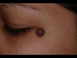 Mole Removal Step-by-Step Removal Guide